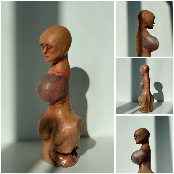 The Goiter